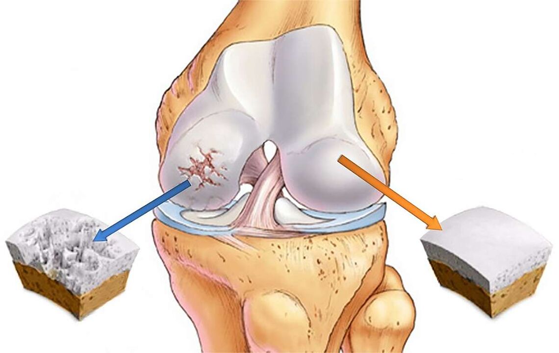 Knee cartilage destruction and knee joint disease