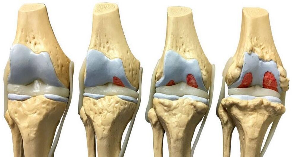 Stages of development of knee joint disease