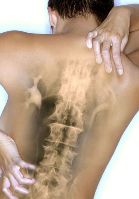 Back pain due to thoracic osteochondrosis