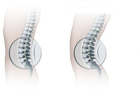 Normal spine with increased lumbar lordosis