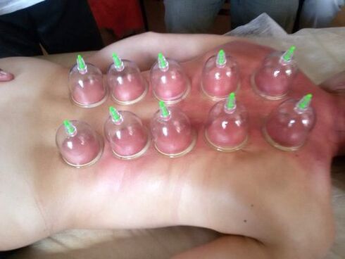 Vacuum cupping is a great way to treat lower back pain at home