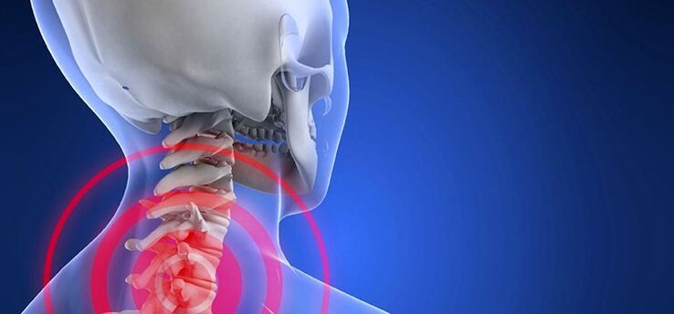 cervical osteochondrosis