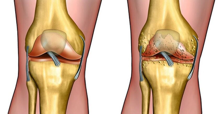 Healthy joints and knee arthritis
